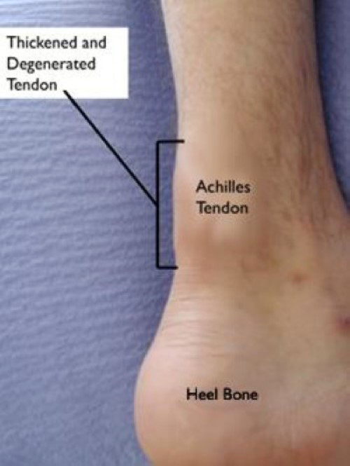 achilles