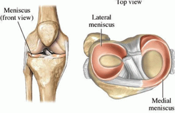 Meniscus tears of the knee