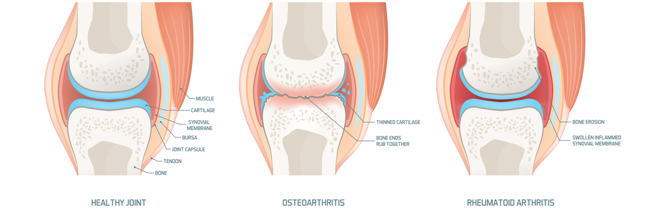 osteoarthritis, can it be reversed?