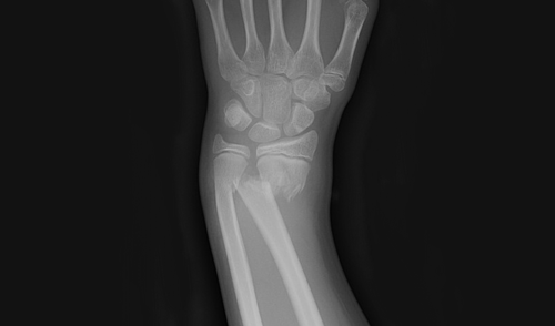 Radius Fracture